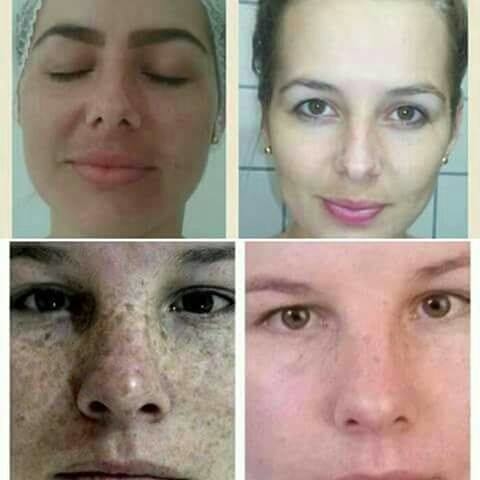 Peeling 3D