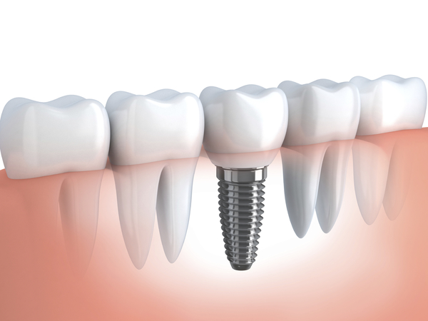 Implante de Dentes - Implantodontia