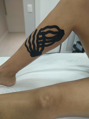 Pós operatório de varizes e Estética